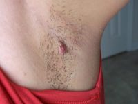 Травматизация папилломы